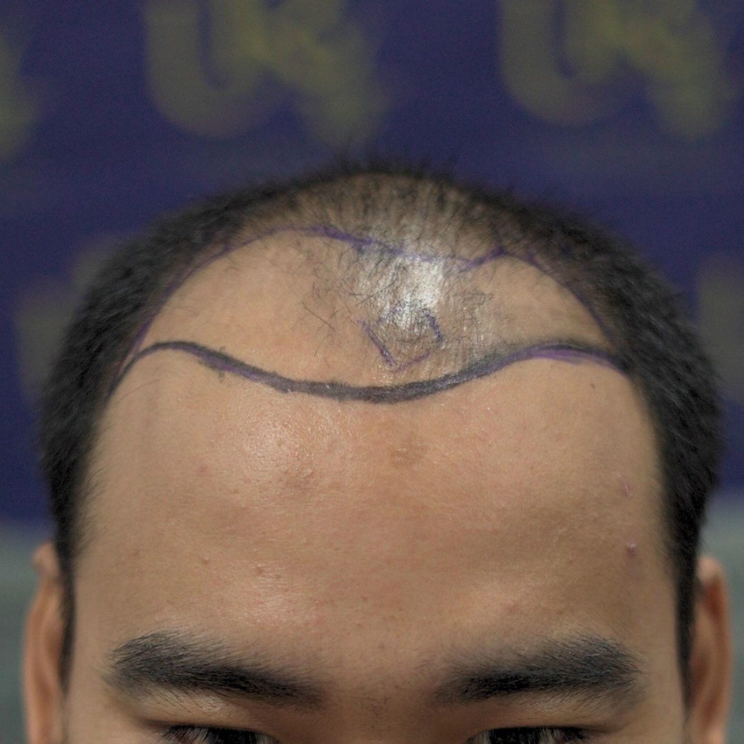 Garis rambut & pelipis before