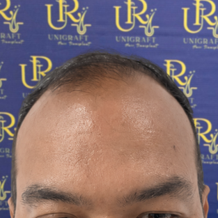Garis rambut depan before